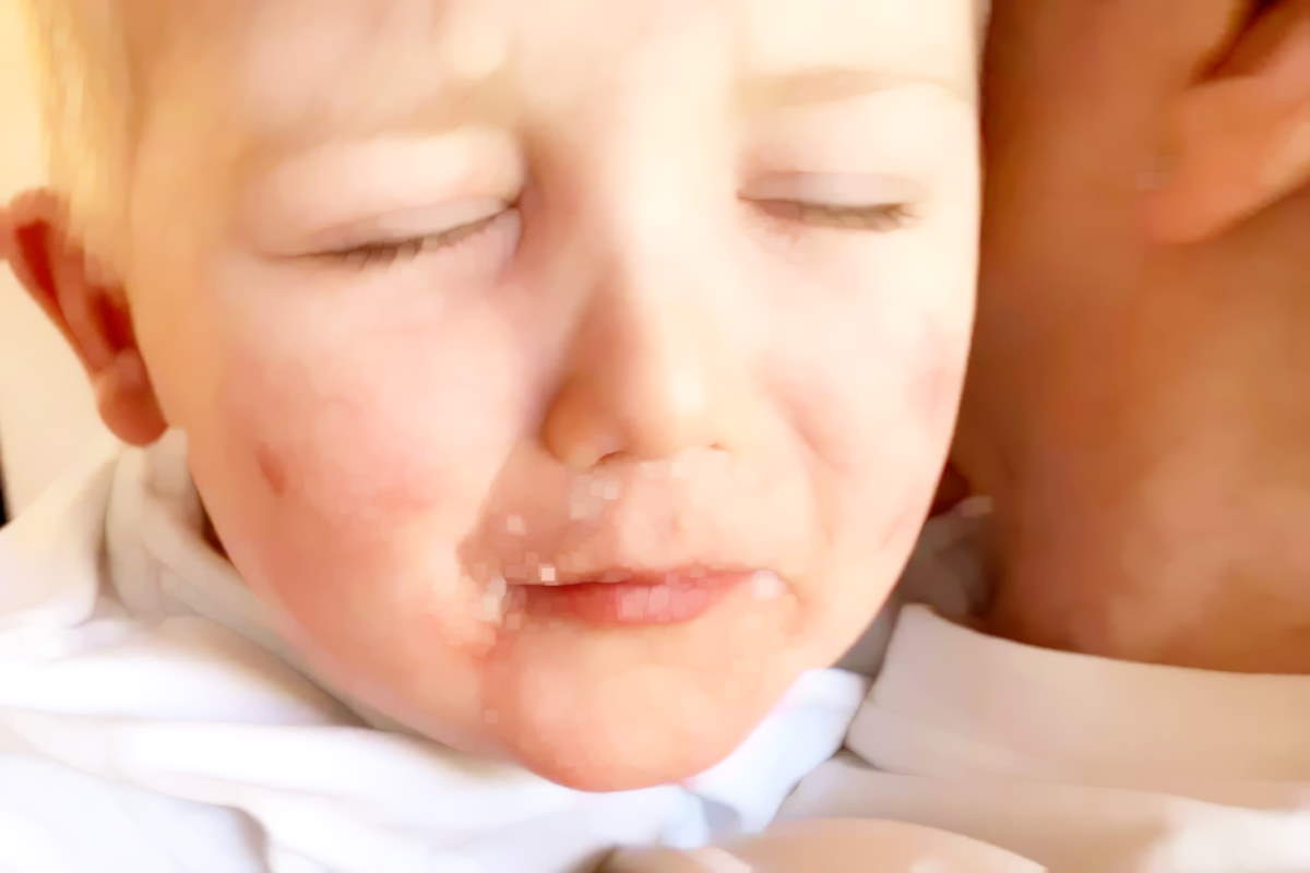 Sindrome di Kawasaki, allarme dei pediatri: effetto collaterale nei bambini con coronavirus