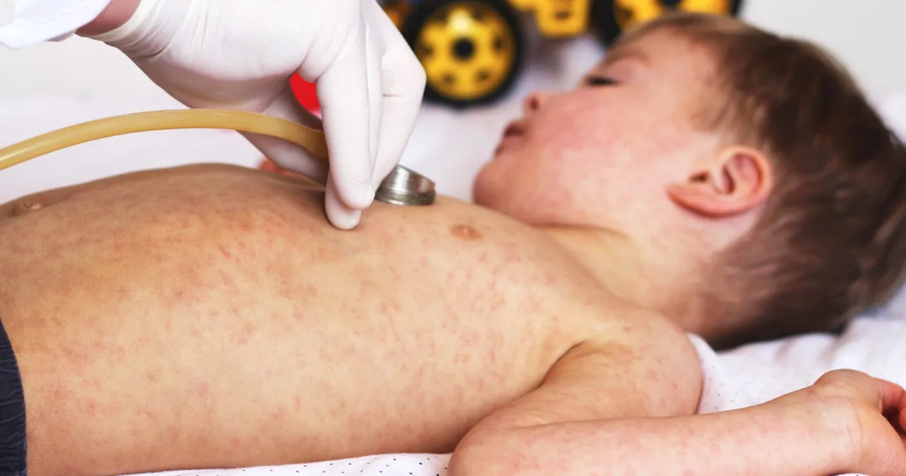 Morbillo: in Italia quasi un cittadino su dieci è ancora vulnerabile. I giovani adulti sono il punto debole