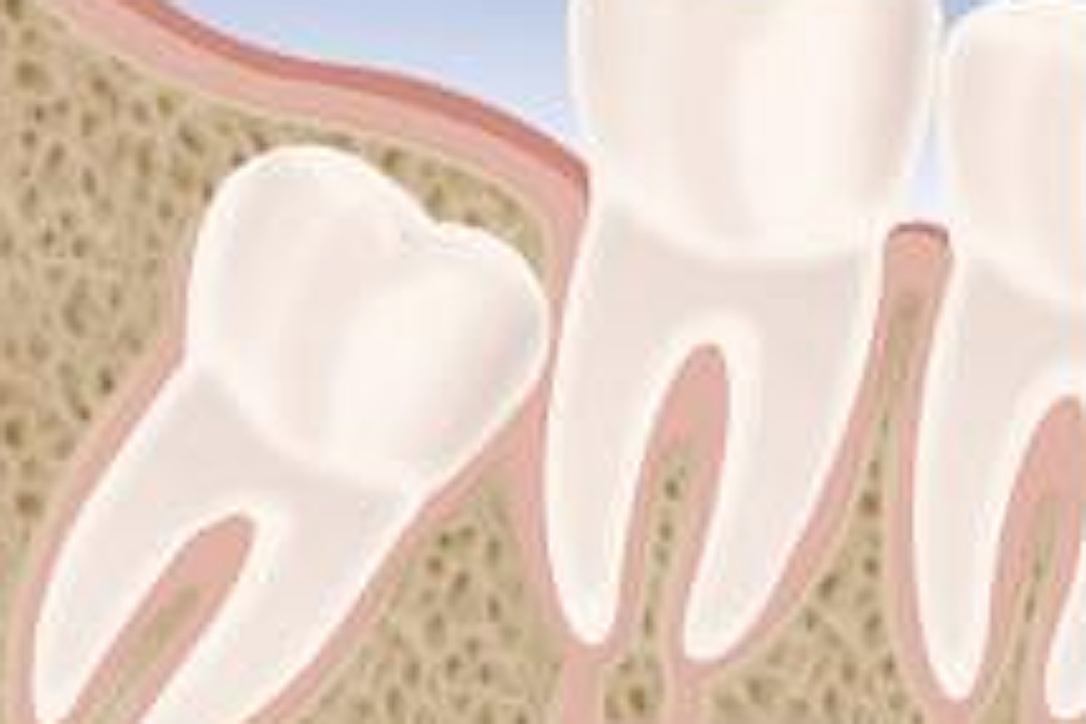 Denti del giudizio: quando rimuoverli?