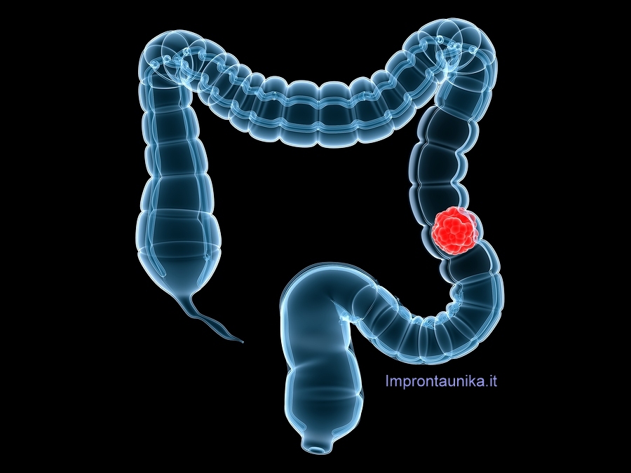 Colon irritabile, in estate attenzione alla dieta